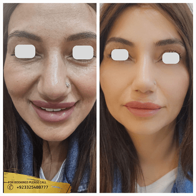 Botox in Islamabad, pakistan - Real patient before and after results