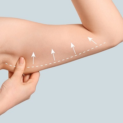 How Much Skin is Removed During an Arm Lift?