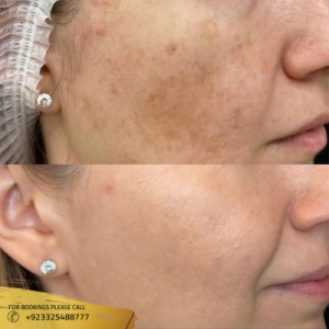 skin pigmentation before after in islamabad