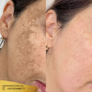 skin pigmentation best results in islamabad
