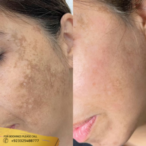 skin pigmentation in islamabad