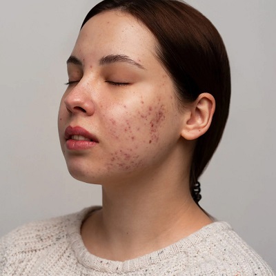 Are Acne Scars Impossible To Remove