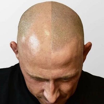 Can Scalp Micropigmentation be removed