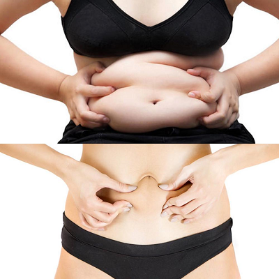 Fat Removal Surgery Cost in Pakistan