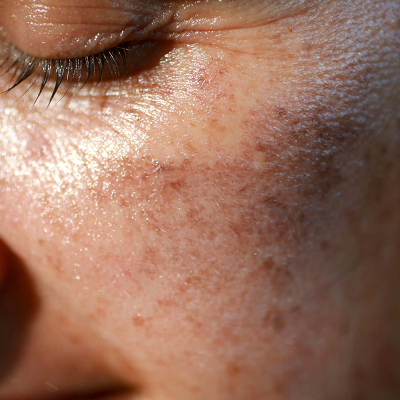 How does skin pigmentation occur?
