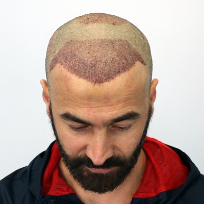 How soon after a hair transplant can I wash my hair?