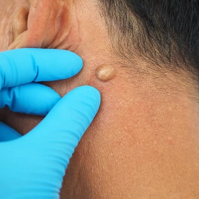 Is a Lipoma on the neck dangerous or not?