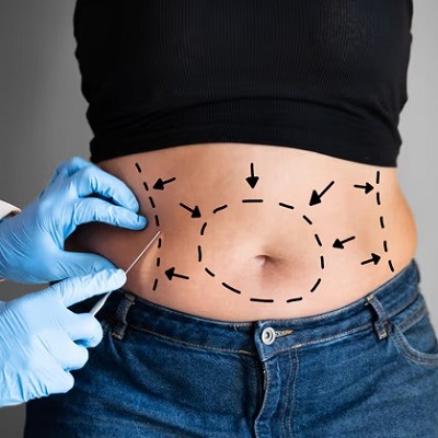 Liposuction: Methods, Results, Recovery, Risks & Benefits in Islamabad