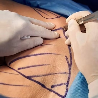 What is bariatric surgery?