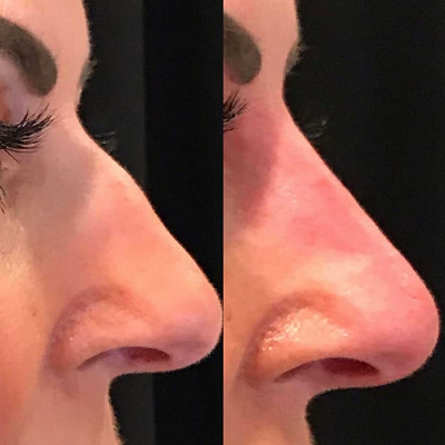 What liquid is used in Non-Surgical Rhinoplasty?