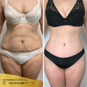 liposuction-in-treatment-before-and-after (1)