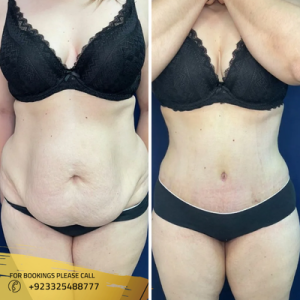 liposuction-surgery-before-after-picture (1)