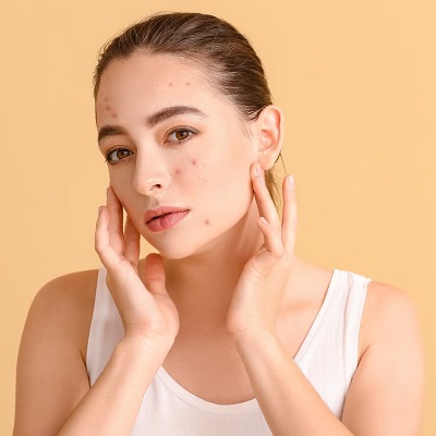 Are Pimples a Sign of Hormonal Imbalance?