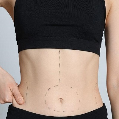 Does Bariatric Sleeve Surgery Take Away Cravings?