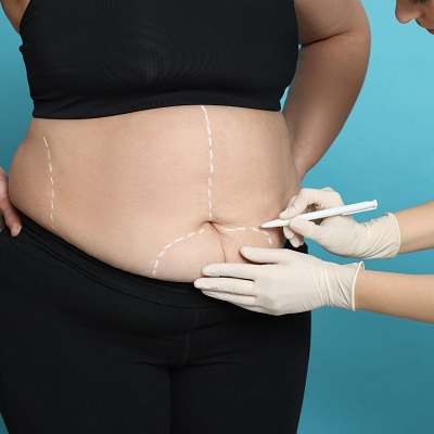 How Much Weight is Lost After Bariatric Surgery?