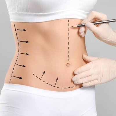 How long is the recovery after a tummy tuck?