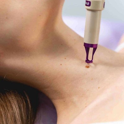 Is It Better to Remove a Mole or Leave It?