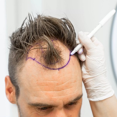 Is Scratching Safe After a Hair Transplant?