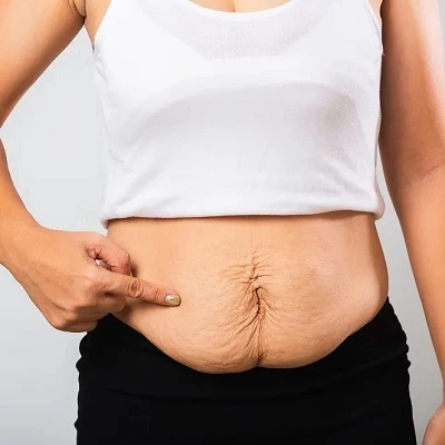 Can I Live a Normal Life After Bariatric Surgery?