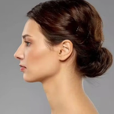 Can I smile 3 weeks after Rhinoplasty?