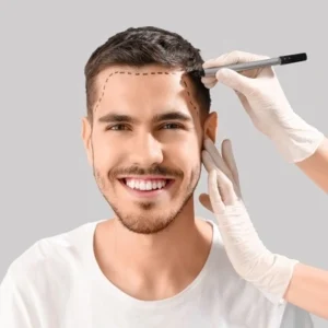 Can I use a trimmer after a hair transplant?