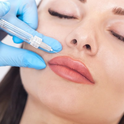 Dermal Fillers for Upper Lip Lines