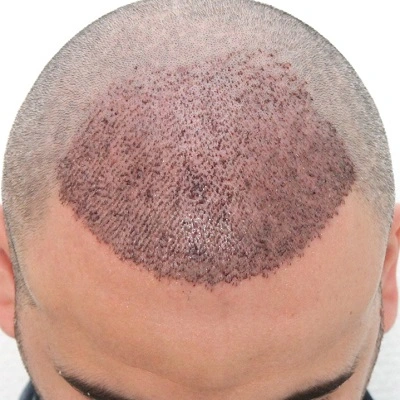 When Does a Graft Stabilize?