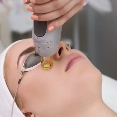 Best Laser Treatments For Dark Spots and Uneven Skin