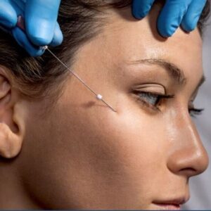 Can I walk after PDO threads