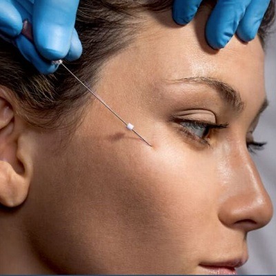 Can I walk after PDO threads