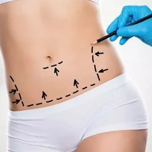 How Much Should I Walk After Abdominoplasty?