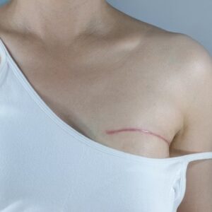 How to sleep after a breast lumpectomy?