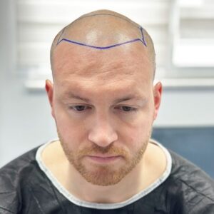 Is it safe to touch grafts after a hair transplant?