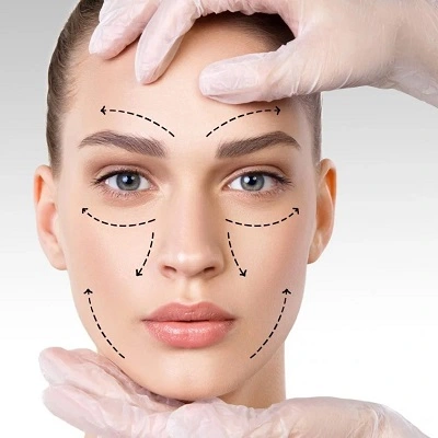 What is a Cinderella Facelift?