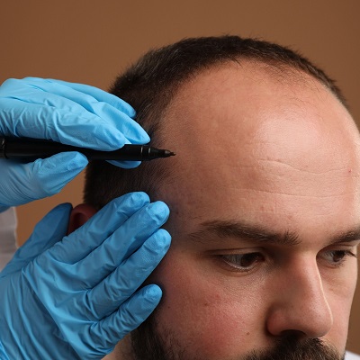 When Can I Wear A Hat After A Hair Transplant?