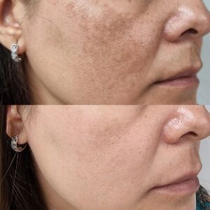 microdermabrasion before after results