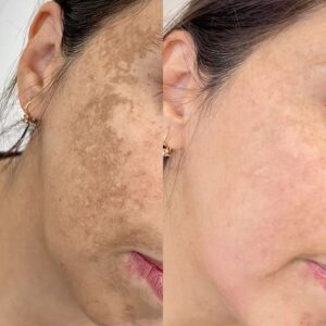 microdermabrasion in islamabad