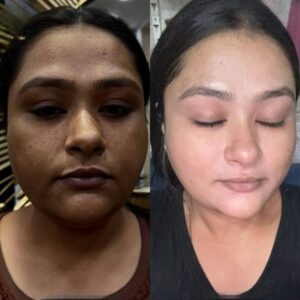 permanent skin whitening injection