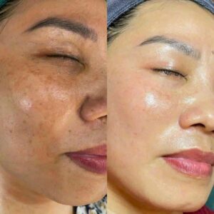 real results of microdermabrasion in islamabad