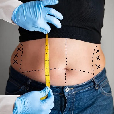 Can I Do Bariatric Surgery Twice?