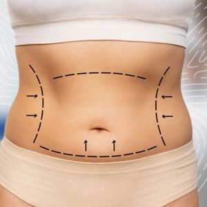 Can You Walk After Thigh Liposuction?