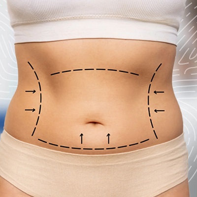 Can You Walk After Thigh Liposuction?