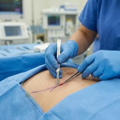 How Long Is Bed Rest After Laparoscopic Surgery?