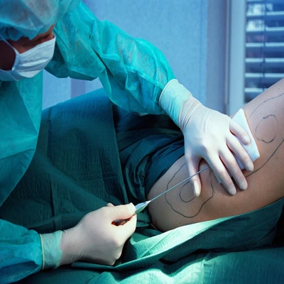 Liposuction in Islamabad - Best Surgeon for Liposuction in Pakistan